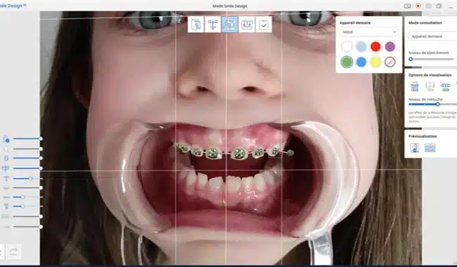 Smile Design mode ortho