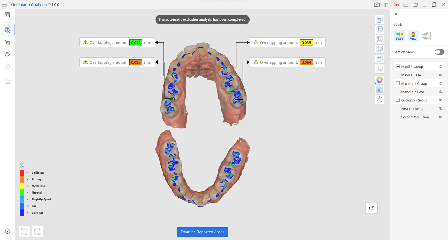 Medit Occlusion Analyzer est sorti !