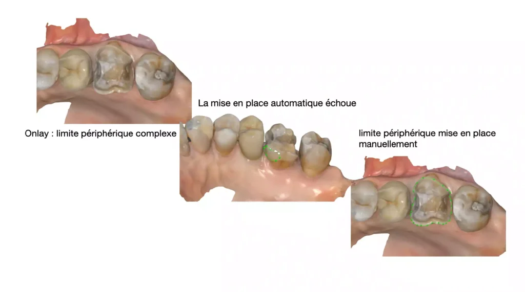 Labocast3D_Medit_Capture_Medit-Link-avec-IA-partie-2_photo11-min