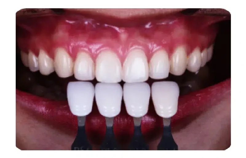 Les facettes en zircone ZirNEERS 5