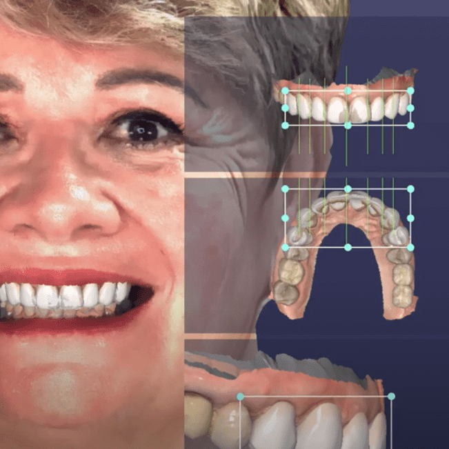 Utilisation du RAYFace – Smile Design avec import