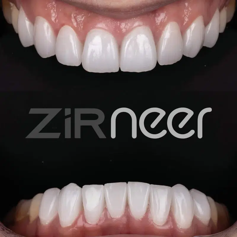 ZIRNEER