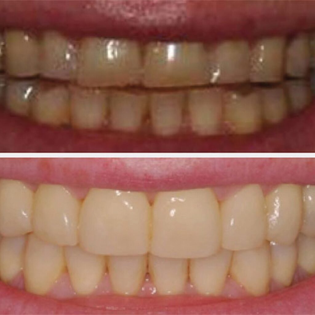 set up 1600px fit veneer (10)-min