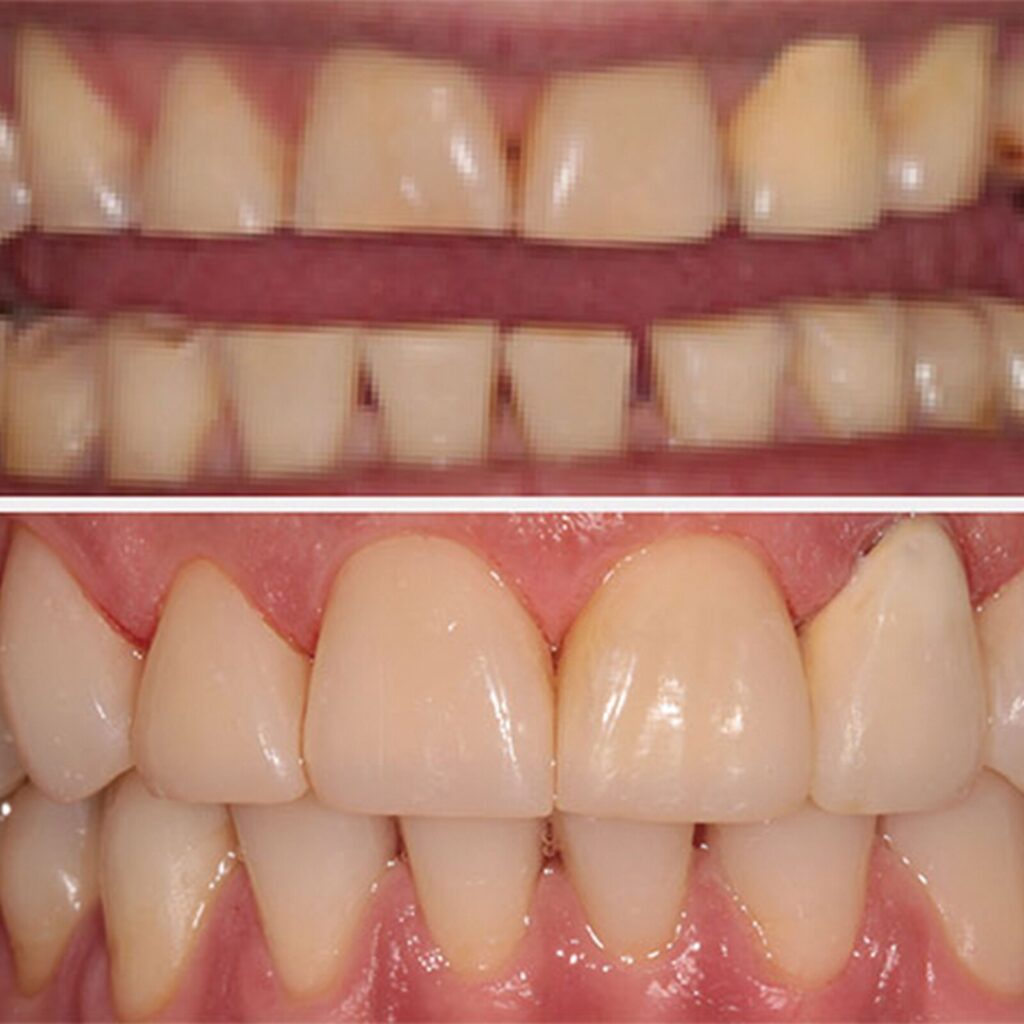 set up 1600px fit veneer (9)-min