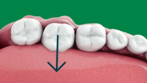 Positions ectopiques