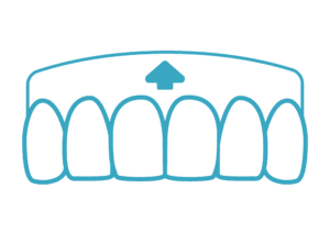 Augmentation de la couverture gingivale