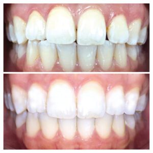 Cas cliniques aligneurs dentaires TrioClear®
