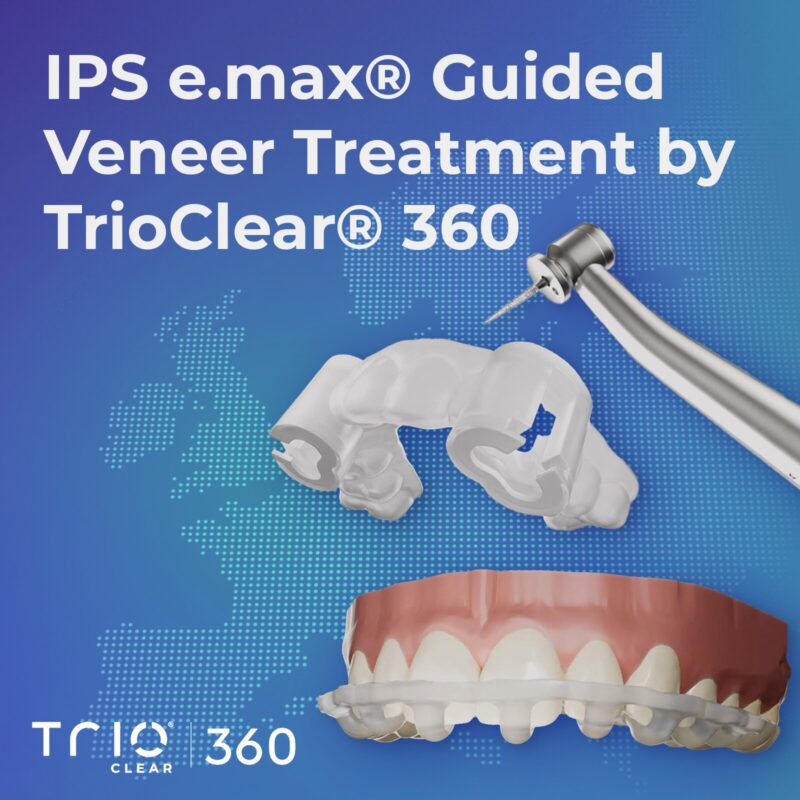 IPS e.max® Guided Veneer by TrioClear® 360